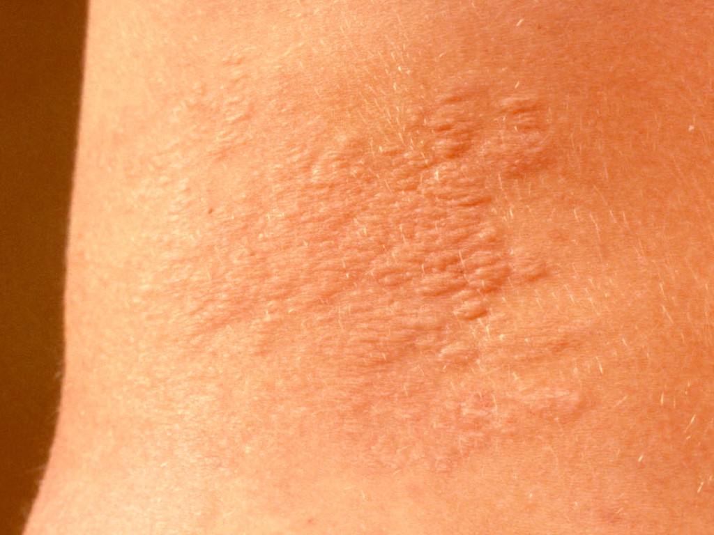 Shagreen Patches Stepwards