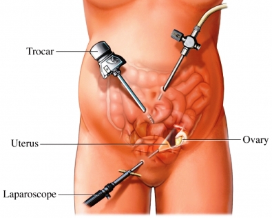 A LAVH utilizes laparoscopic techniques to help remove the uterus in a patient (source) 