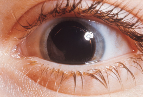 A fixed dilated pupil can often be seen in patients with a epidural hemorrhage (source) 