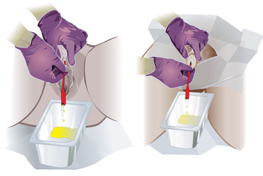 The usage of a straight catheter may be required to obtain a urine sample in patients with delirium (source) 