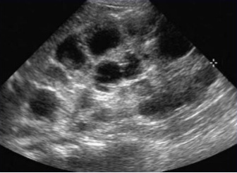 Multiple renal cysts may be present in some patients with tuberous sclerosis (source)