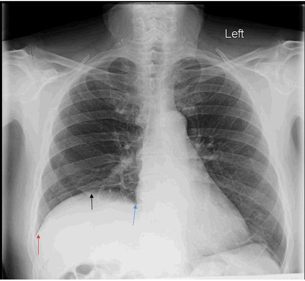 This X-ray shows an elevated right hemidiaphragm that is caused by phrenic nerve palsy (source)