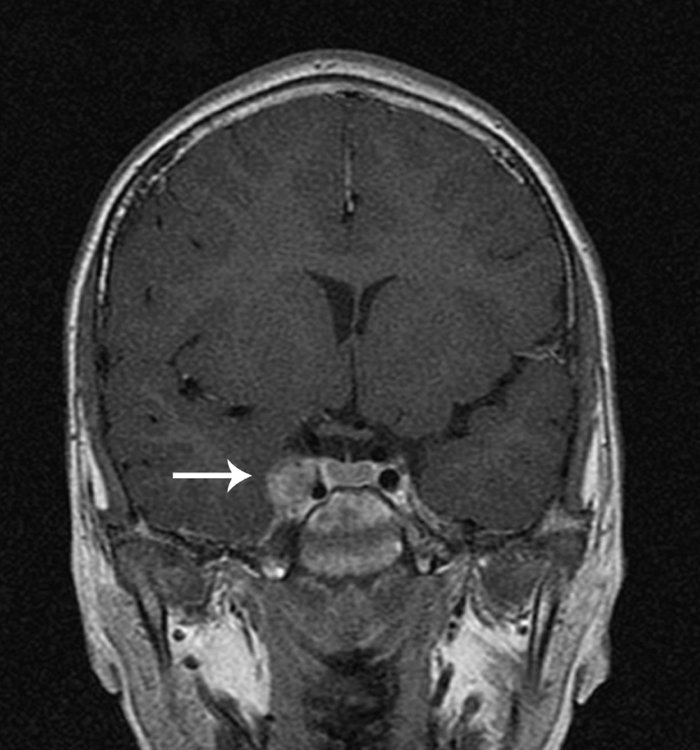 MRI imaging may show features that support the diagnosis of CST. In the MRI above the patient has clear enlargement of their right cavernous sinus (source) 