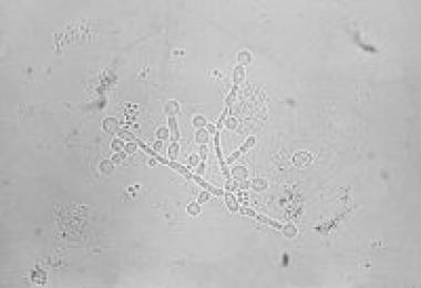 Light microscopy can reveal the presence of fungal organisms with characteristic phseaudohypahe (source)