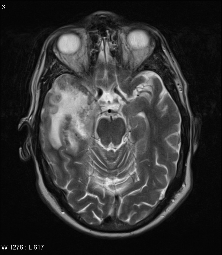 MRI showing a temporal lobe lesion seen in a patient with herpes encephalitis (source)