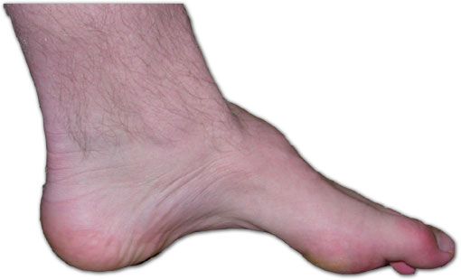 Characteristic high arches often seen in Charcot-Marie-Tooth disease (source)