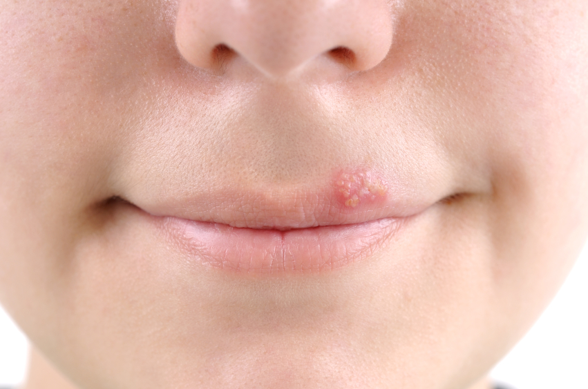 HSV-1, the same virus responsible for cold sores (oral herpes), is most often the cause of herpes encephalitis (source) 