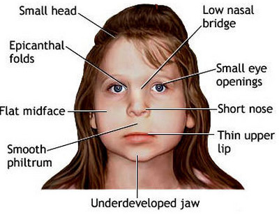 Physical exam findings in FAS (source)