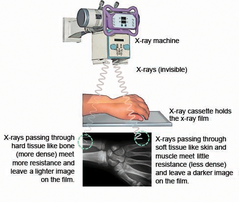 This image helps demonstrate the basics of how X-ray technology is used clinically (source)