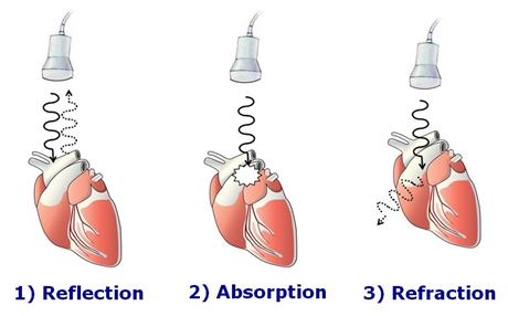 It is important to appreciate that ultrasound not only produces sound waves, but records the ones waves that are reflected back towards the probe (source)