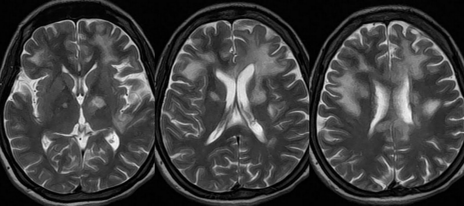 T2 MRI images showing demyelination caused by PML (source)