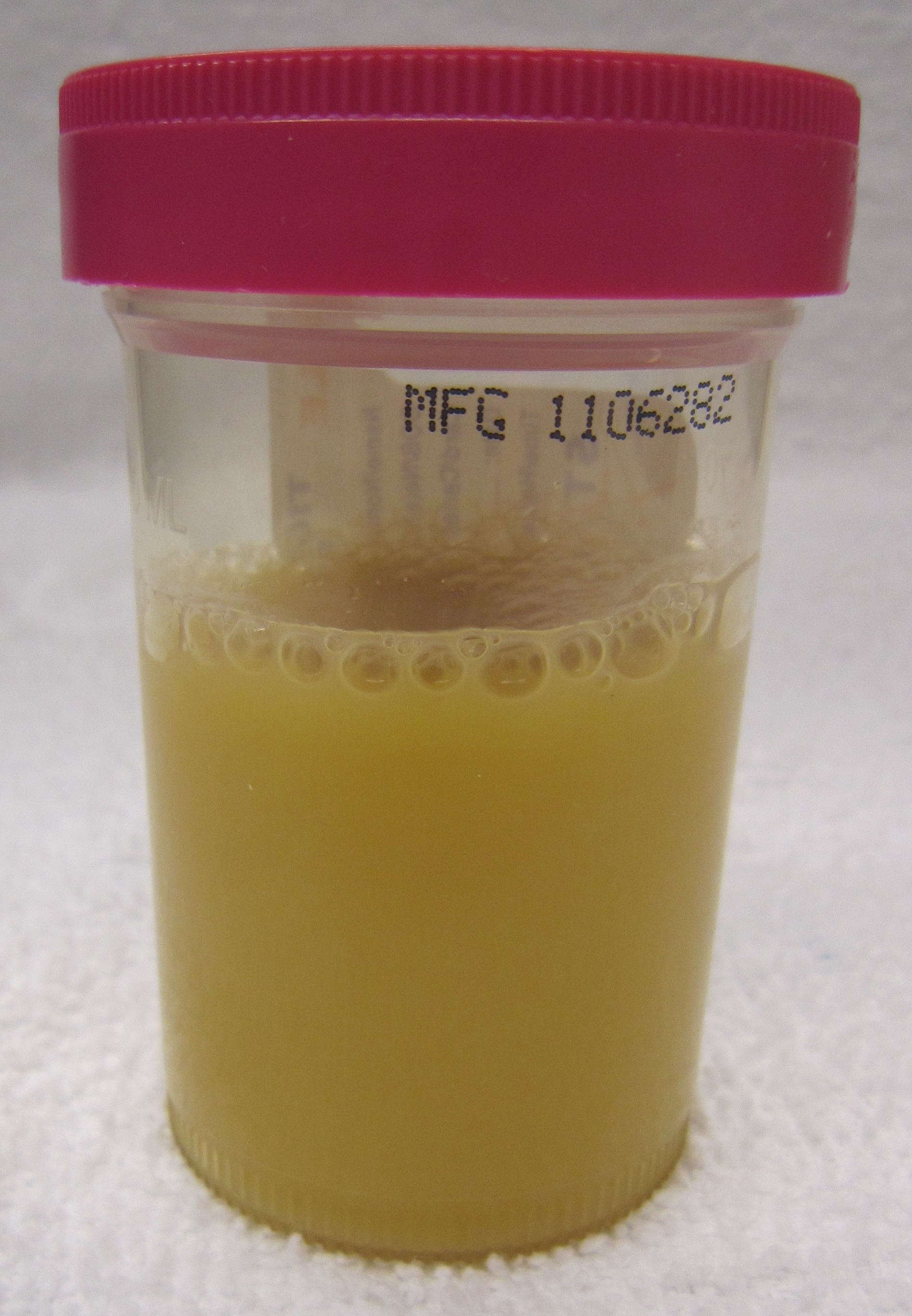 Not every UTI progresses to the point of producing purulent urine (shown above) however urine studies are key in raising our suspicions for a UTI (source)