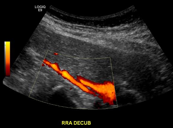 I this renal artery duplex ultrasound, both the structure of the renal artery can be visualized, as well as the blood flow through the vessel (the bright color represents blood flow, source) 