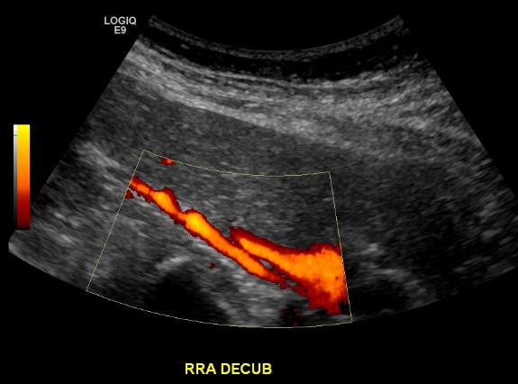 I this renal artery duplex ultrasound, both the structure of the renal artery can be visualized, as well as the blood flow through the vessel (the bright color represents blood flow, source)