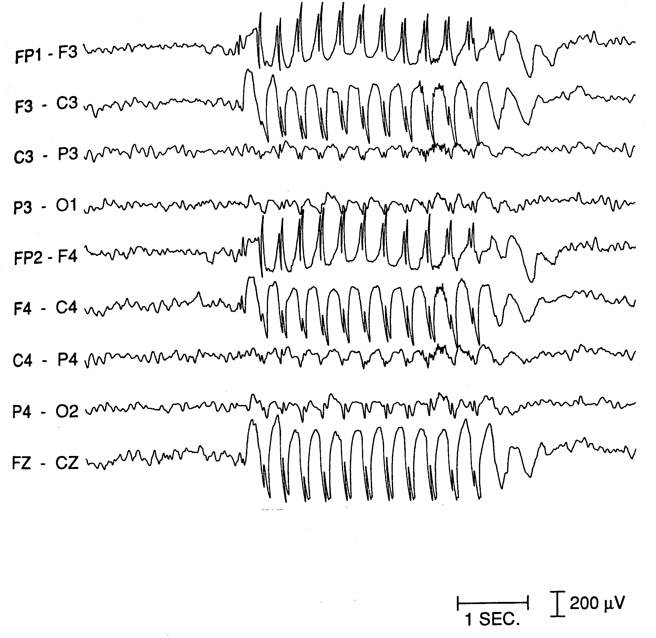 This EEG shows the characteristic absence seizure generalized pattern. There is an alternating "spike" and "wave" pattern that occurs 3 times a second (source)
