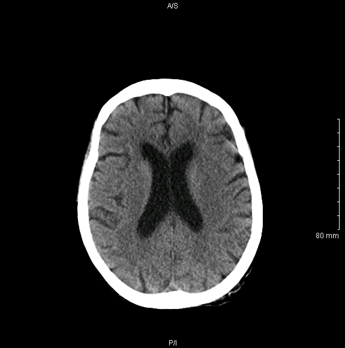 Axial orientation of a non-contrast head CT (source)