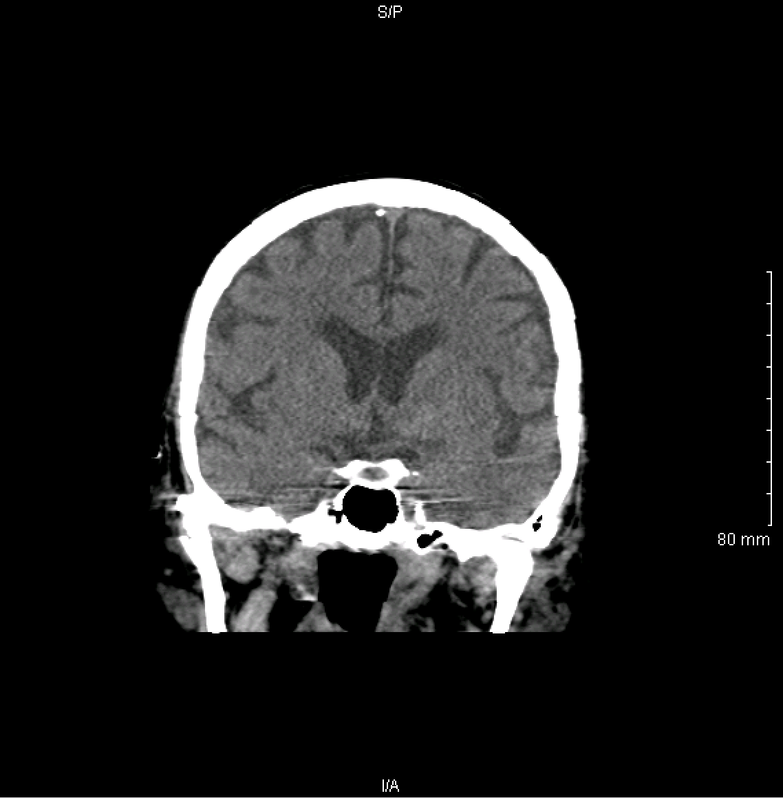 Coronal view of a non-contrast head CT scan (source) 