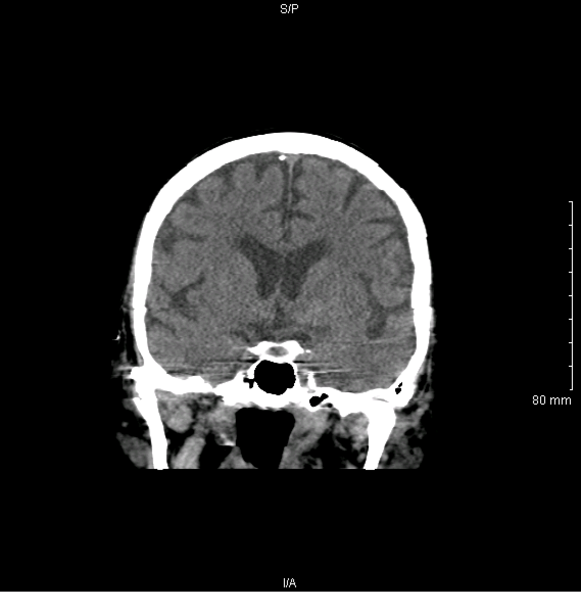 Coronal view of a non-contrast head CT scan (source)
