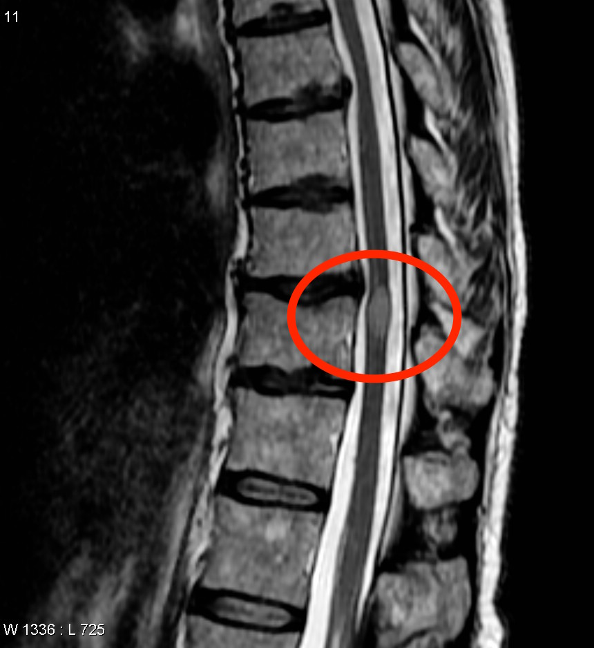 MRI image showing transfer myelitis (source)