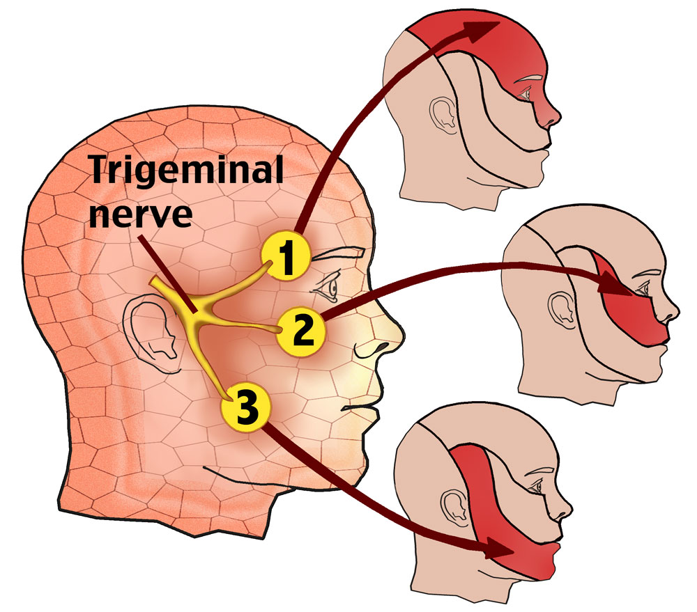Trigeminal neuralgia is characterized by pain in areas innervated by the branches of the trigeminal nerve (source) 