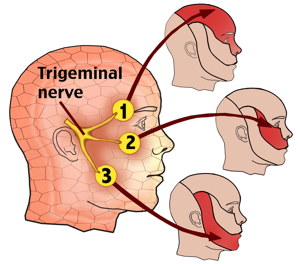 Trigeminal neuralgia is characterized by pain in areas innervated by the branches of the trigeminal nerve (source)
