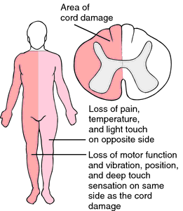 This unique distribution of motor and sensory loos may be observed in patients with transverse myelitis (source) 