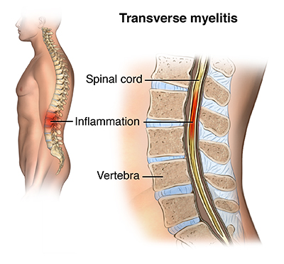 Anatomical representation of transverse myelitis (source)