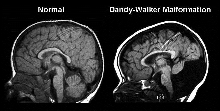 Comparison between a normal scan and a scan of a patient with a Dandy-Walker malformation (source)