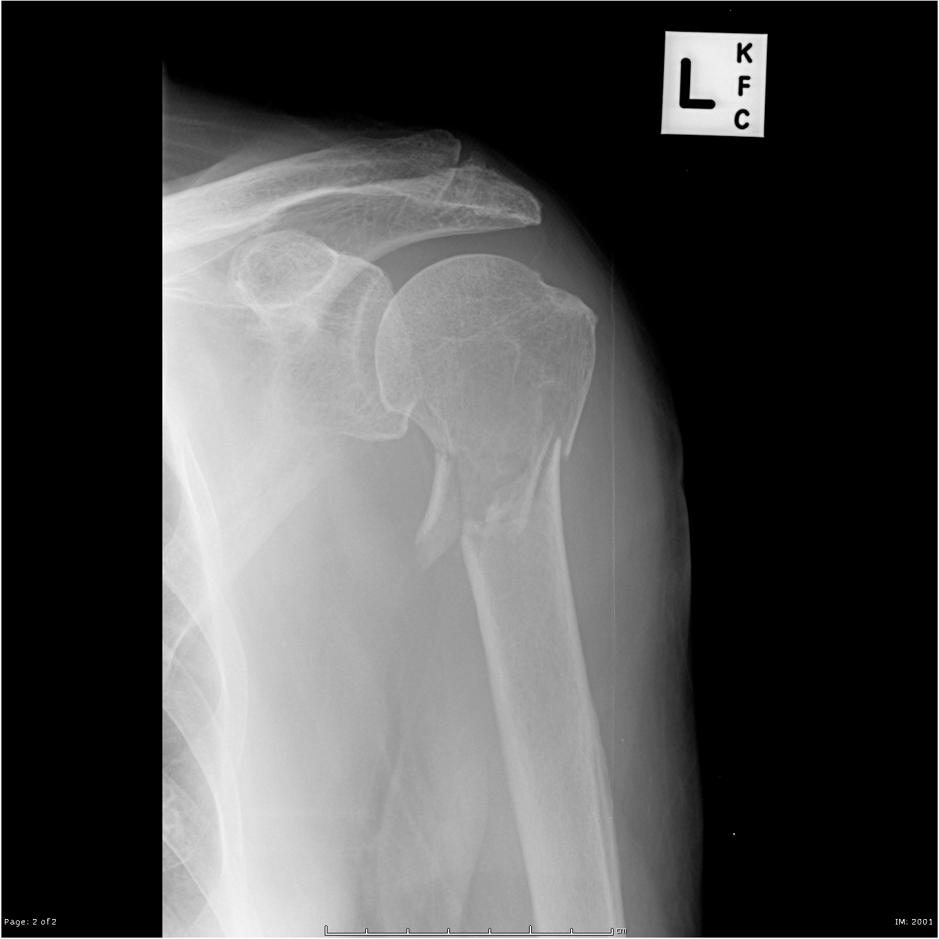 This X-ray film shows a fracture of the surgical neck of the humorous. It is this type of injury that can often affect the axillary nerve (source)