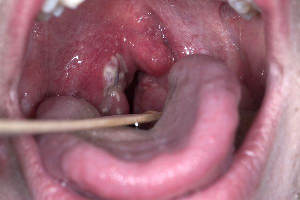 A swollen pharynx, enlarged tonsils, and presence of exudate all can support the diagnosis of strep throat (source) 
