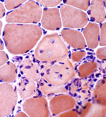 Muscle biopsy of a patient with DMD showing muscle fiber necrosis (source) 