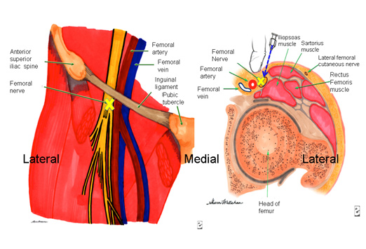 The ideal site of a femoral nerve block is just lateral to the femoral artery, right at the inguinal crease (source)