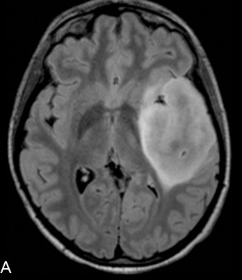 MRI can help evaluate for the presence of any pathology that can explain the occurrence of focal seizure activity in patients (source)