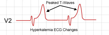 Certain EKG findings (such as the peaked T waves shown above) are characteristic for hyperkalemia (source)