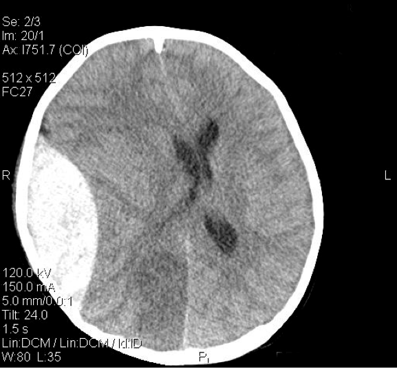 This CT scan shows a large epidural hematoma that could benefit from neurosurgical intervention. The value of the CT scan is detecting cases like this one and securing the appropriate treatment for patients (source)