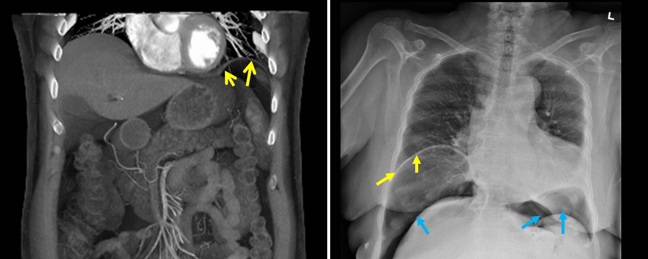 The CT scanned image on the left, while similar in certain components to the plain film on the right, is created digitally (source)