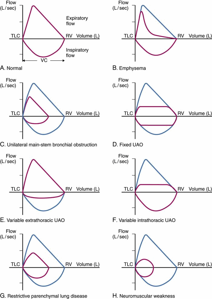 Different diseases can have varying shapes with regards to the flow/volume loop (source)