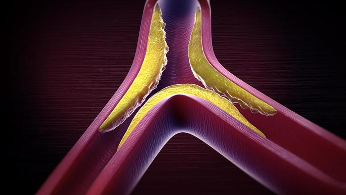 Hyperlipidemia is an important health topic that affects a large fraction of individuals around the world. It is in part responsible for vascular disease (pictured above, source). 