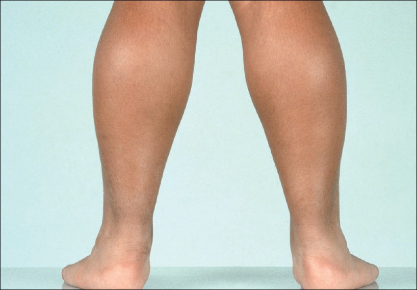 Enlarged calfs seen in a patient with DMD (source)