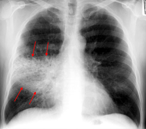 While the pulmonary exam section of our physical exam can raise suspicions, it is ultimately the chest X-ray that confirms many pulmonary infections. In this context we need a systematic approach to deciding what antibiotic to give patients (source)