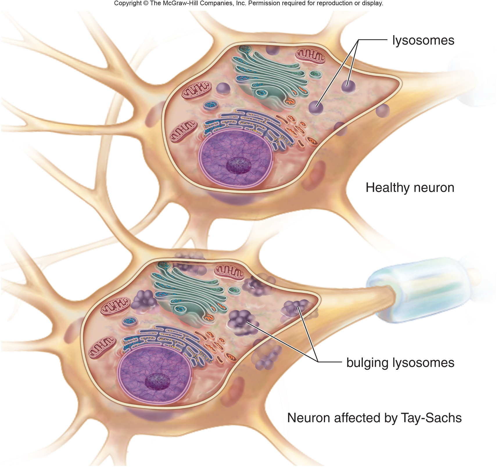 Accumulation of GM2 gangliosides within the lysosomes of neural cells will cause swelling and dysfunction (source) 
