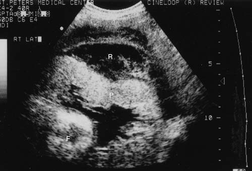 This ultrasound study shows the fetus (F), the placenta (P) and a retroplacental abruption (P, source). 