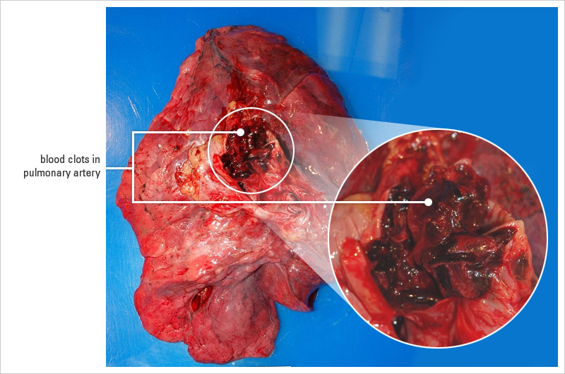 A pulmonary embolism is a "can't miss" diagnosis. That being said...efforts to avoid missing it should not come at the cost of missing the real diagnosis! (source)