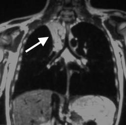 Coronal T1 MRI showing atelectasis of the right upper lobe (source)