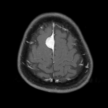 Axial T1 weighted MRI showing a parasagittal meningioma with a characteristic dural tail (source) 