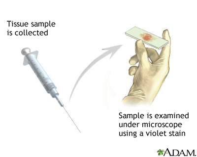 A tissue biopsy can be a very important component of the clinical workup. With that in mind, it is often only a sample of the tissue being biopsied, and does not always represent the entire tissue accurately (source)