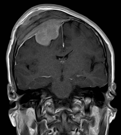 T1 weighted MRI with contrast showing meningioma with characteristic dural tail (source)