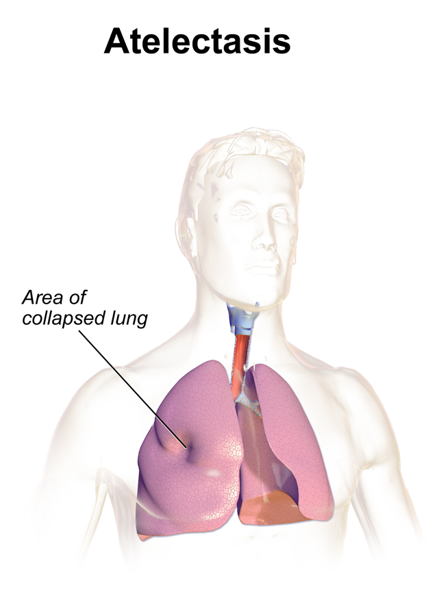 Atelectasis refers to lung collapse, however with the important caveat that the visceral and parietal pleura remain "connected" to one another (source).