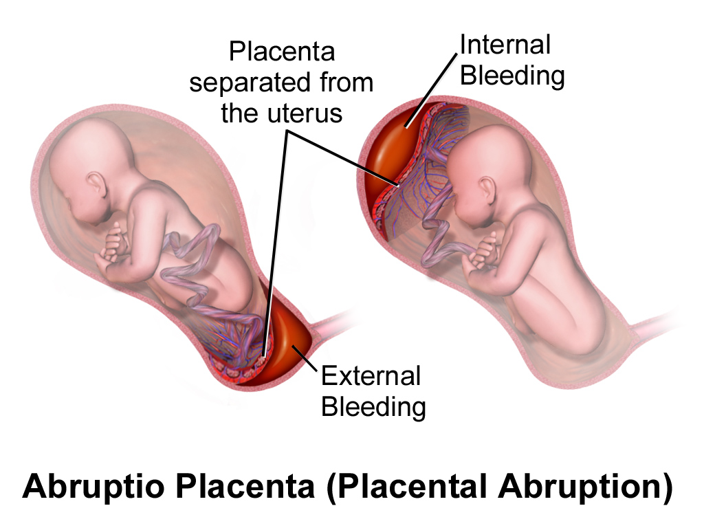 Abruptio placentae can present in a few different ways (with either internal or external bleeding, source).