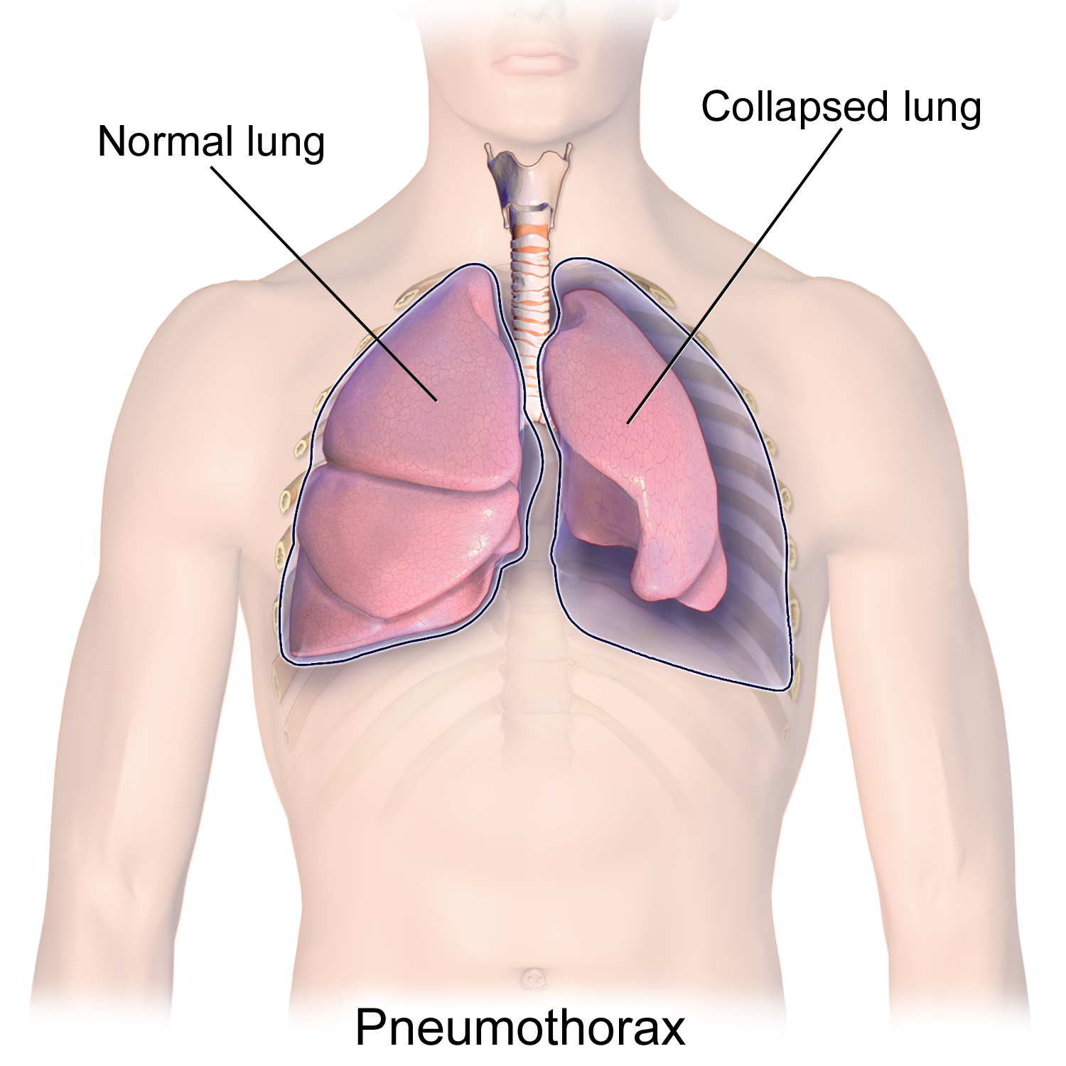A pneumothorax refers to the introduction of free air in the thoracic cavity that causes the collapse of the lung parenchyma (source)